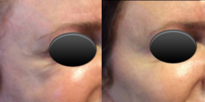 Voluma Before and After