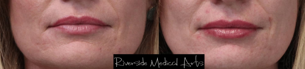 Volbella-11a-before-post-1030x235