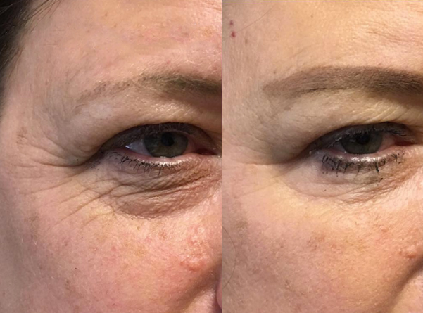 botox-02a-before-post