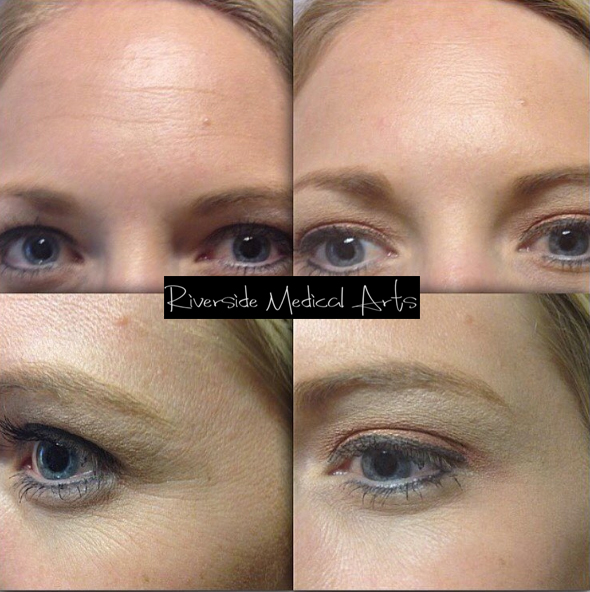 botox-05a-before-post