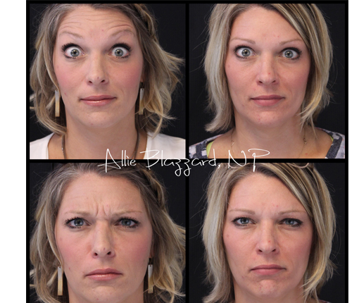 botox-7a-before-post