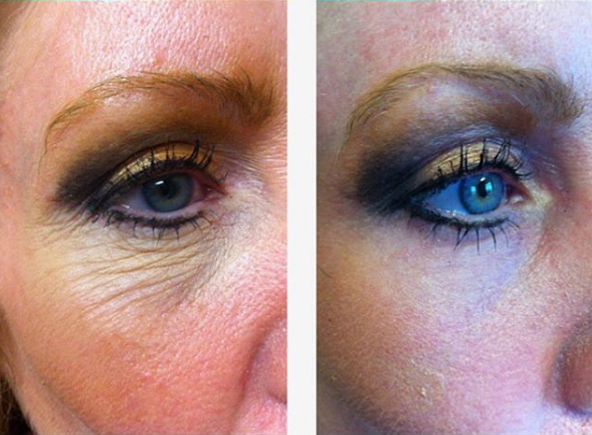 co2-laser-resurfacing-01a-before-post