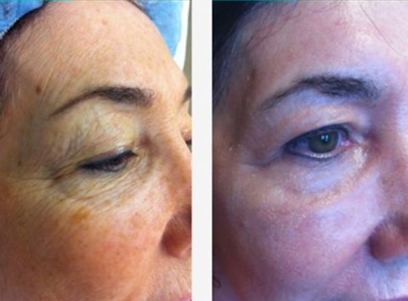 co2-laser-resurfacing-02a-before-post