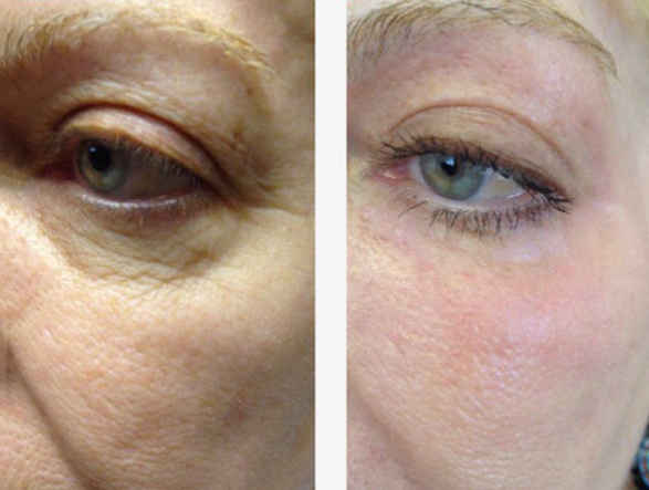 co2-laser-resurfacing-03a-before-post