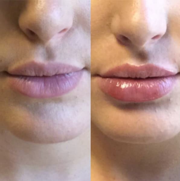 juvederm-02a-before-post