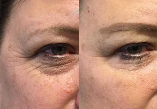 juvederm-03a-before-post