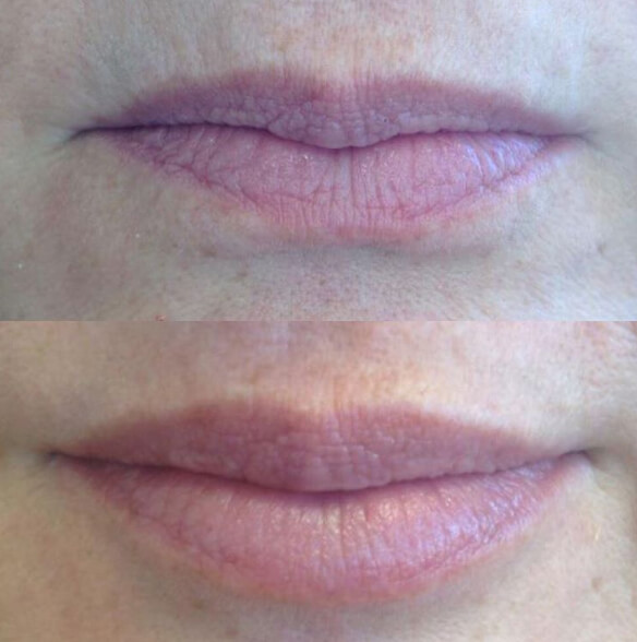 juvederm-04a-before-post