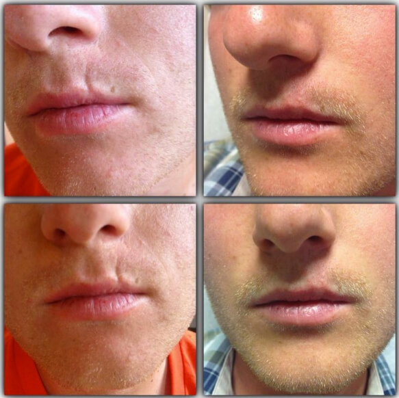 juvederm-05a-before-post