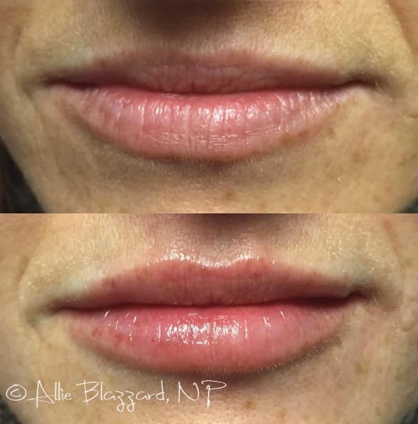 juvederm-06a-before-post