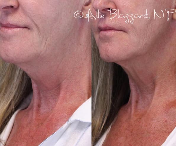 kybella-02a-before-post