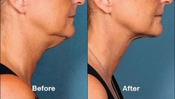 kybella-03a-before-post