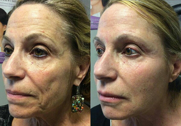 liquid-facelift-01a-before-post