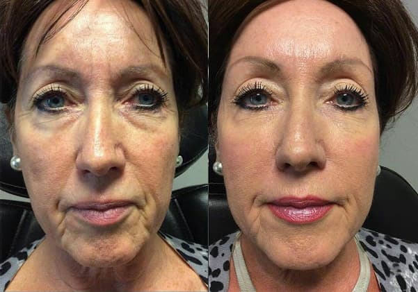 liquid-facelift-02a-before-post