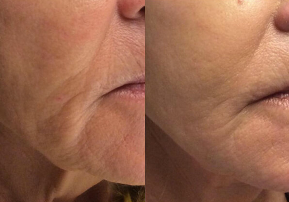 liquid-facelift-03a-before-post