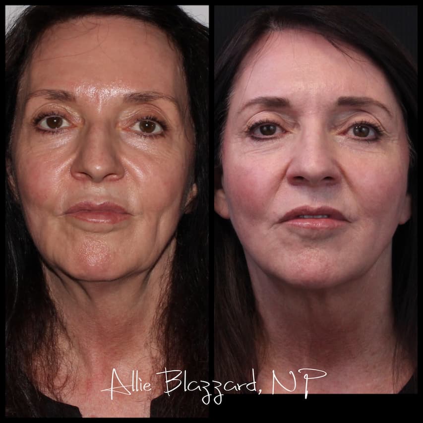 liquid-facelift-04a-before-post