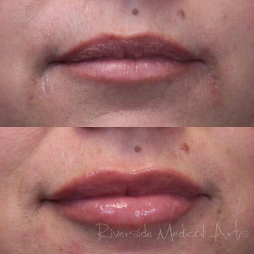restylane-01a-before-post