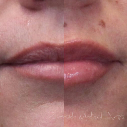 restylane-01b-before-post