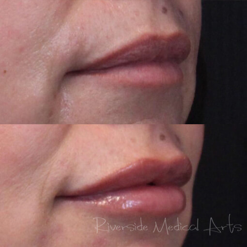 restylane-01c-before-post