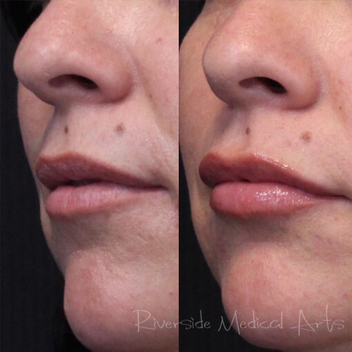 restylane-01d-before-post