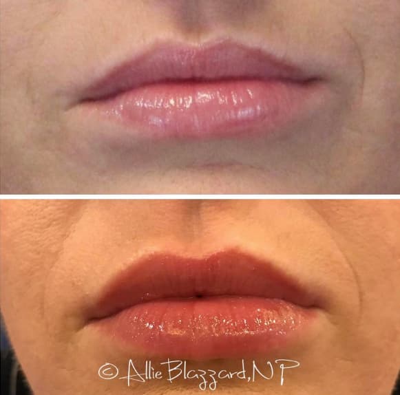 volbella-06a-before-post