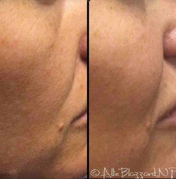 voluma-07a-before-post