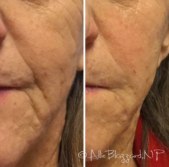 voluma-08a-before-post