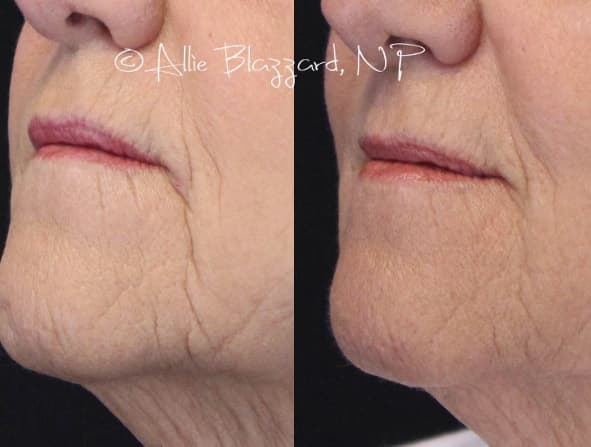 voluma-09a-before-post